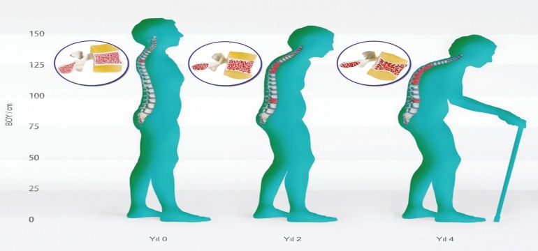 Kalsiyum D Vitamini ve Osteoporoz